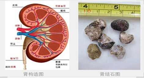 肾结晶≠肾结石